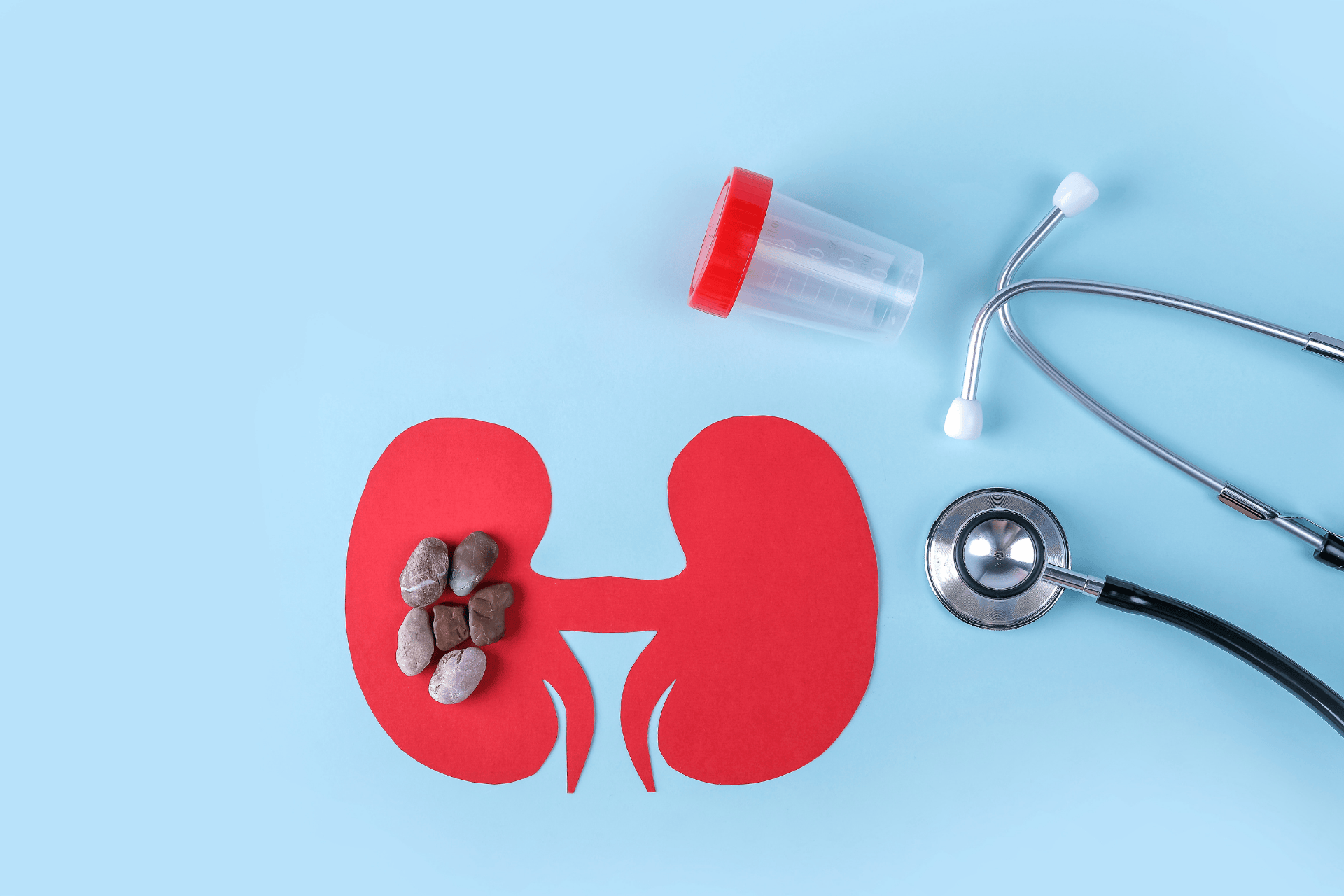 Medical illustration of kidneys with stones placed on one kidney, next to a urine sample cup and a stethoscope.