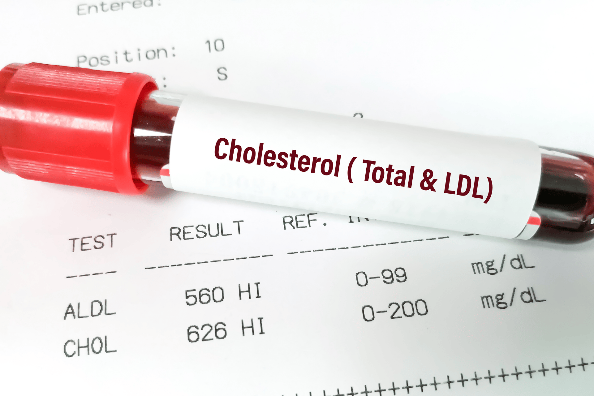 Blood sample labeled for cholesterol testing placed on a lab report showing high cholesterol levels.
