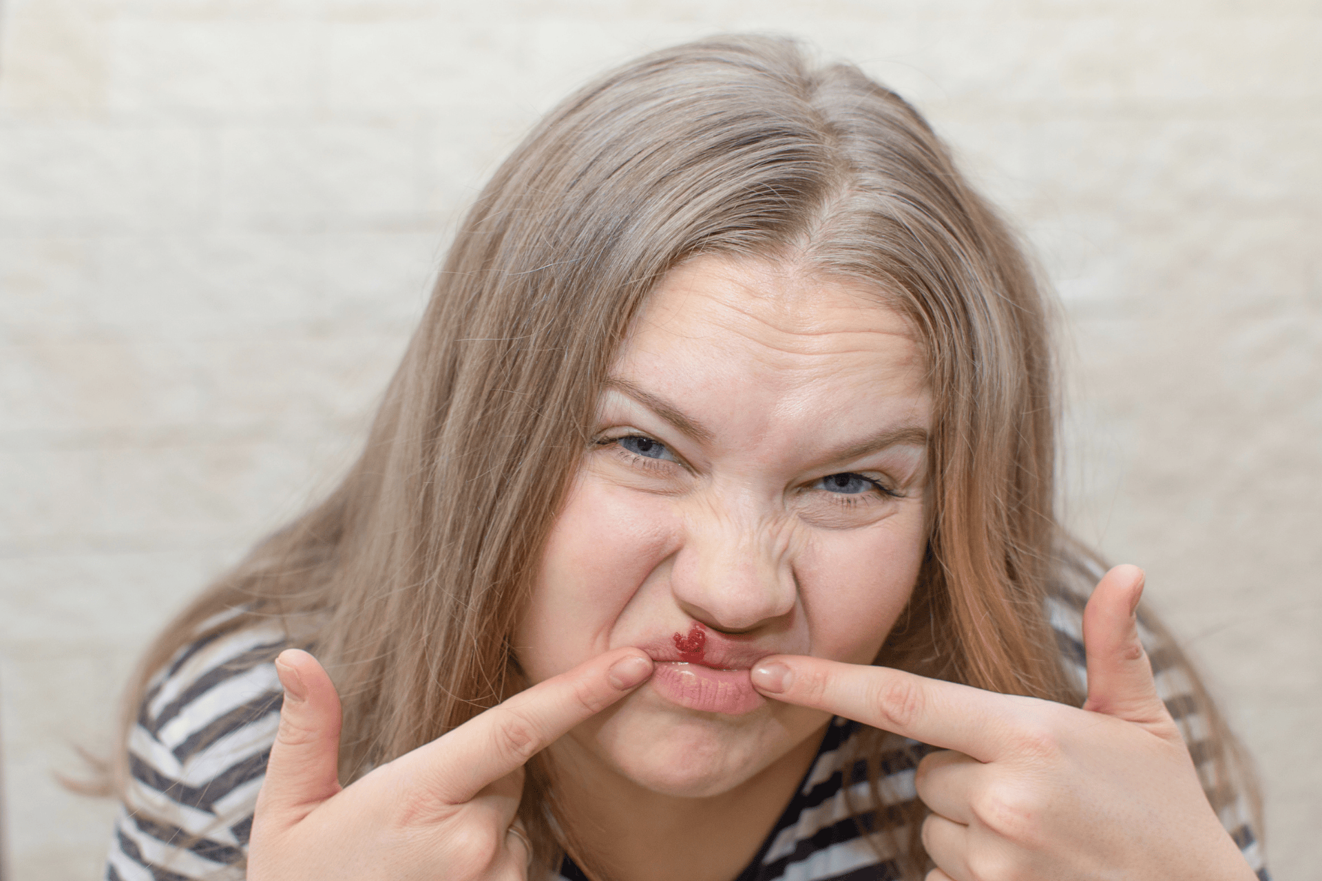 Woman pointing to a red sore on her upper lip.