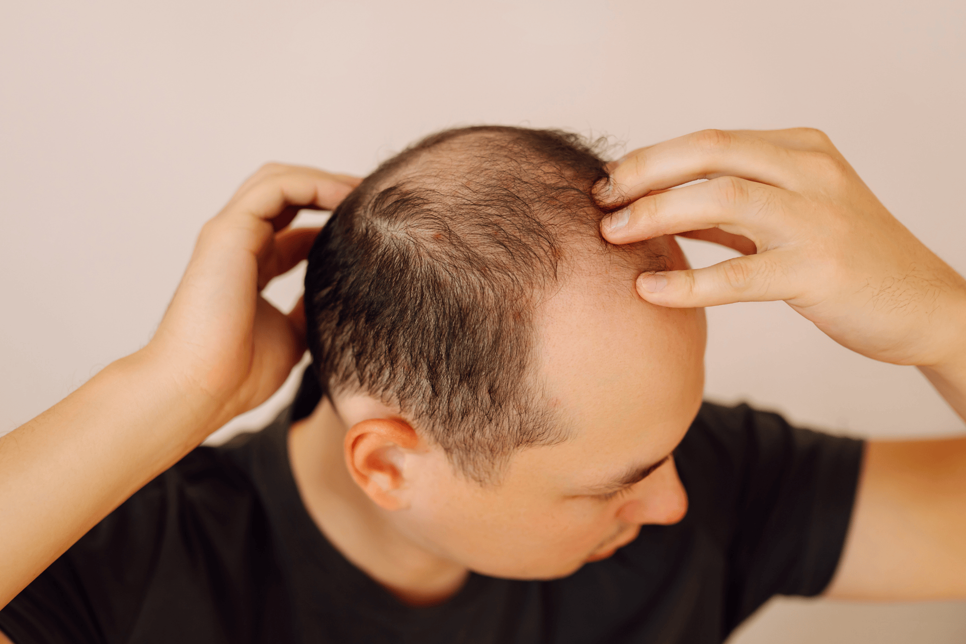 Man examining his scalp, showing noticeable hair thinning and male-pattern baldness.