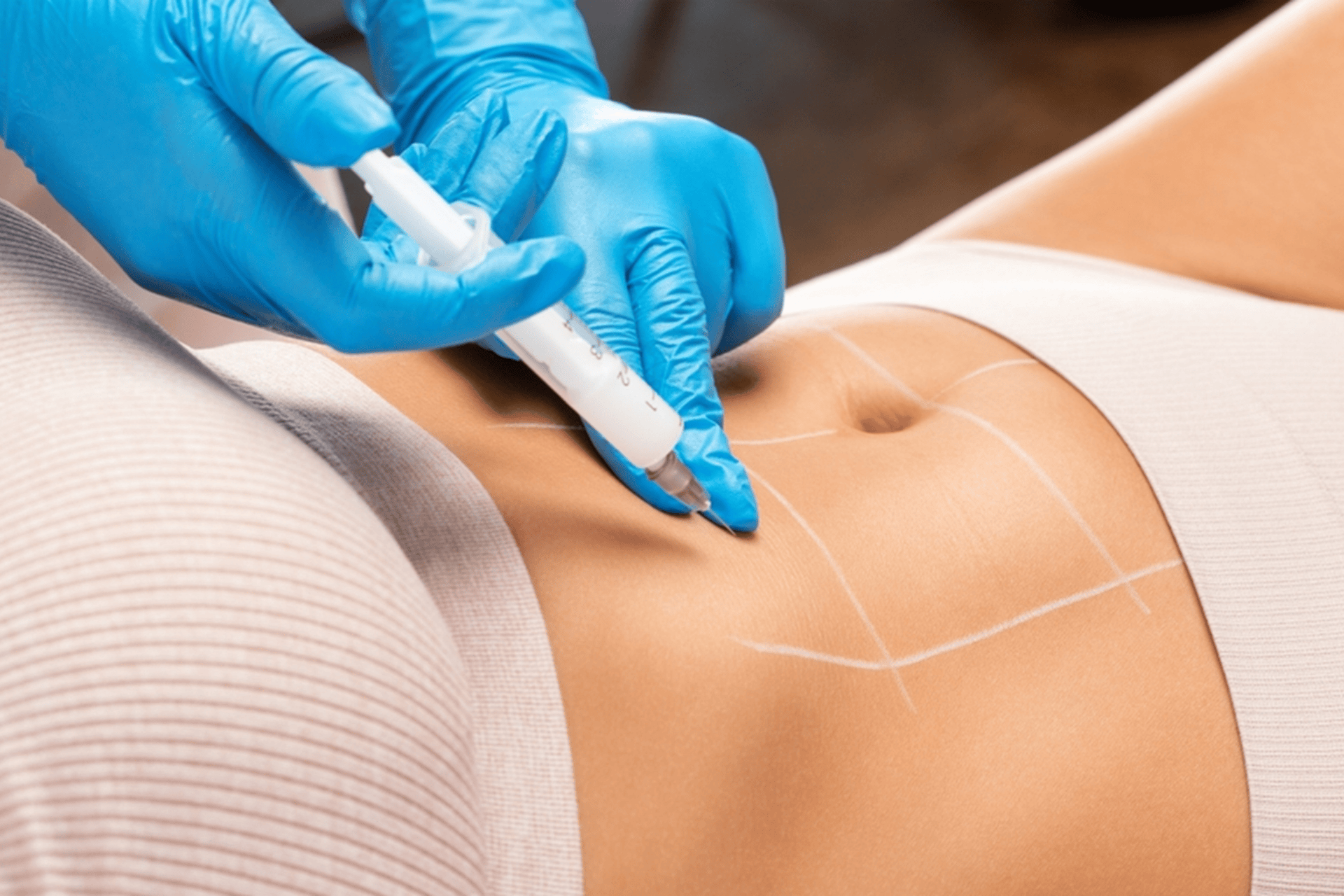 Gloved hands administering an injection into a person’s abdomen, with guide markings drawn on the skin.