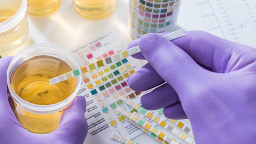 Urine sample being tested