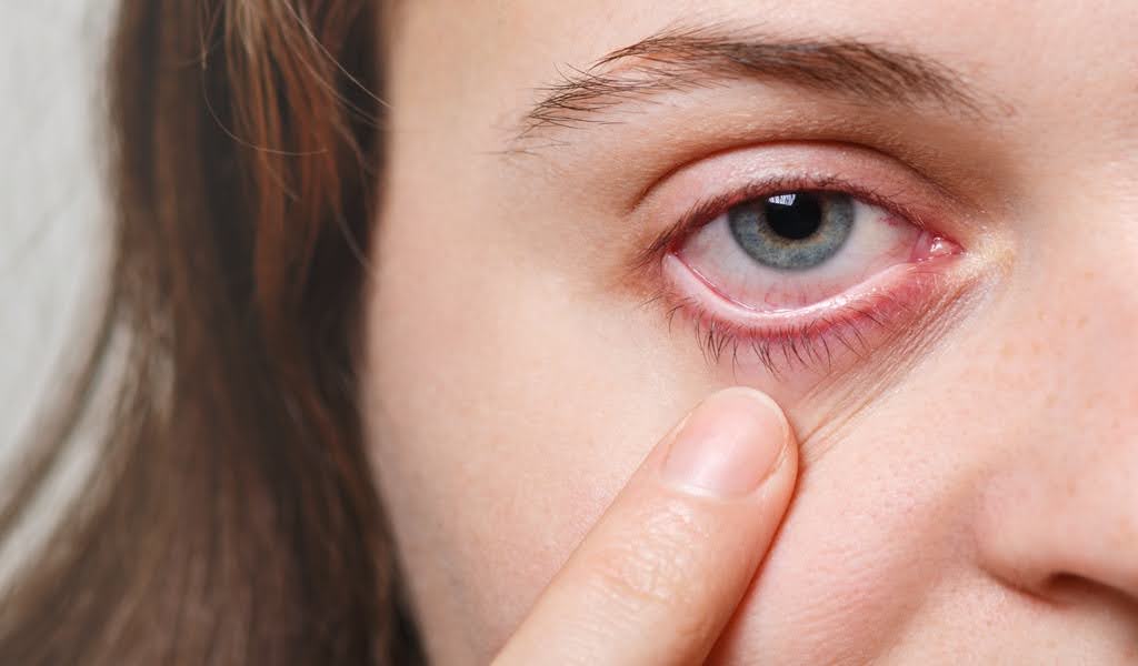 Close-up detail of a woman’s eye with redness and swelling