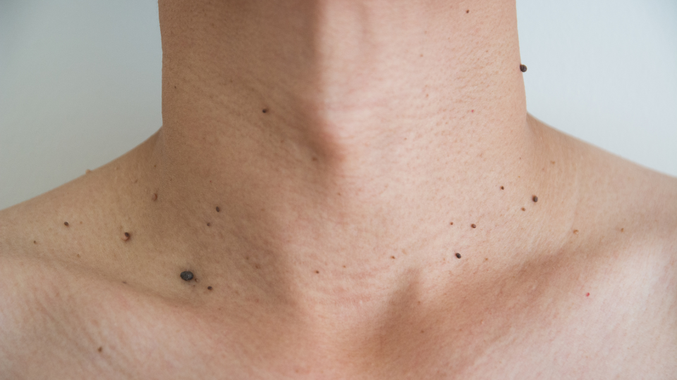 Neck with multiple warts and skin tags
