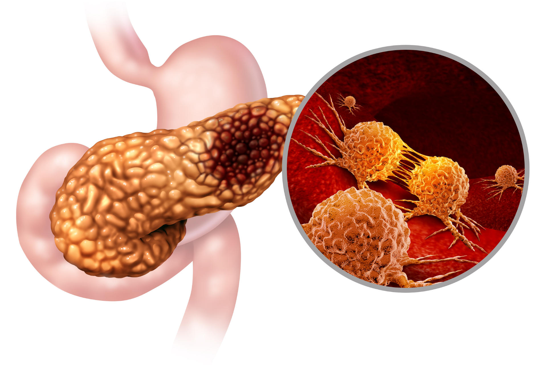 Illustration of pancreatic cancer showing affected cells under magnification.