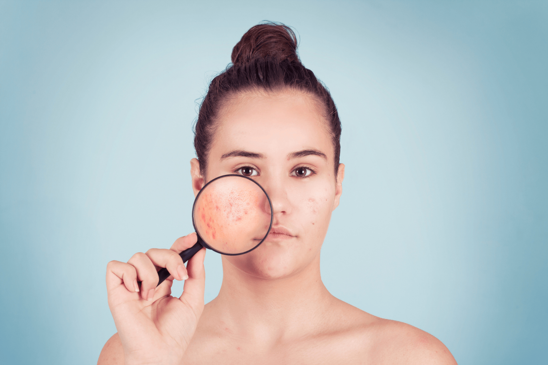 Woman holds a magnifying glass to her cheek, highlighting facial acne and redness