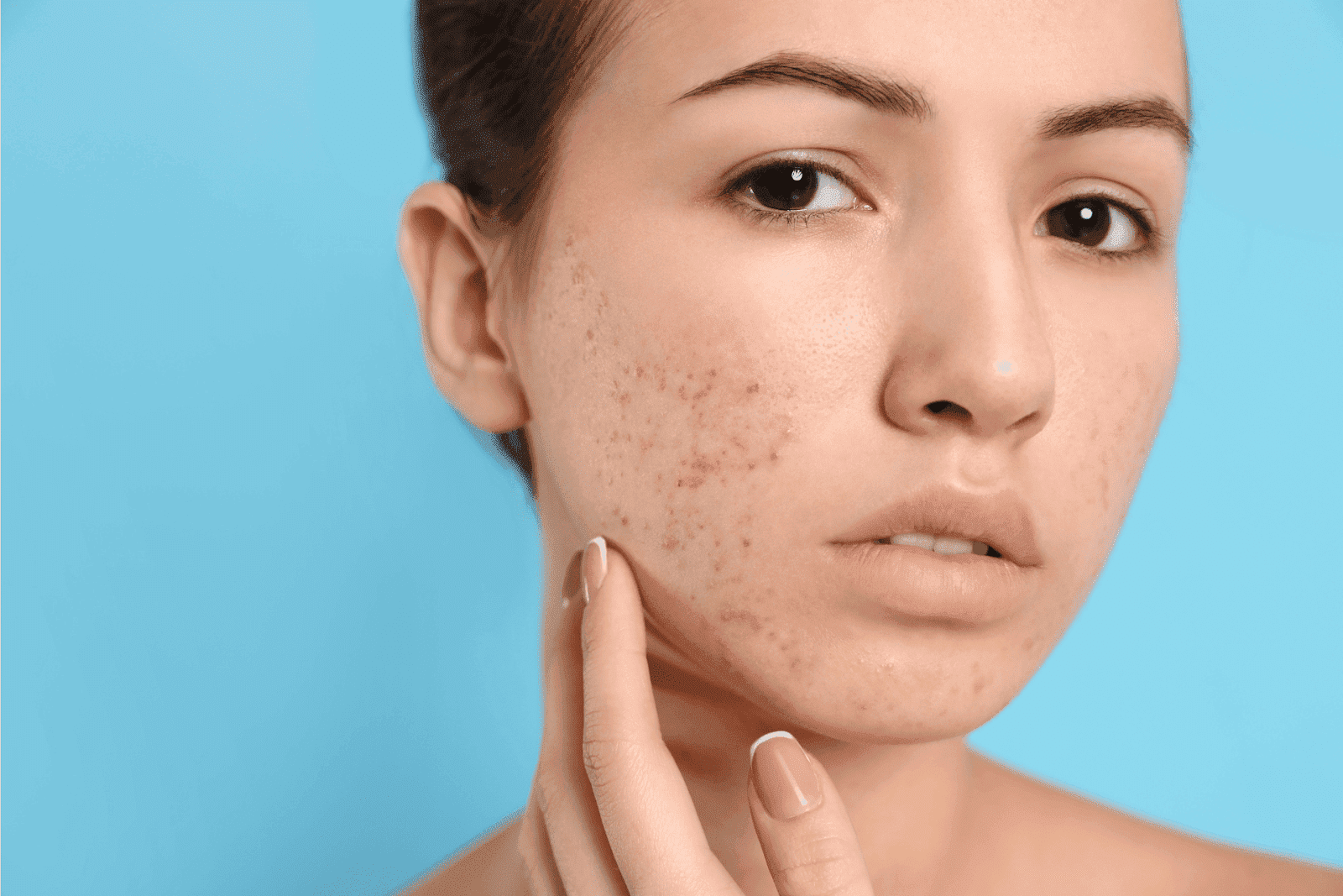 Woman touching her cheek with visible acne and redness.