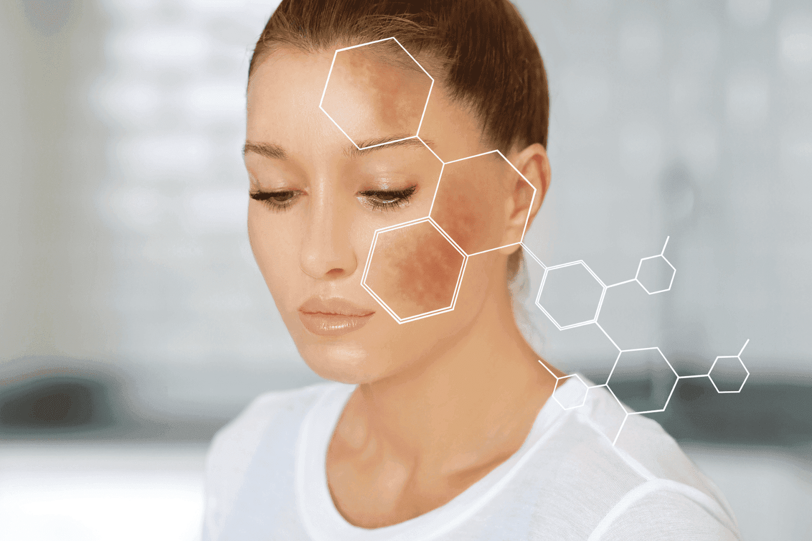Woman with facial hyperpigmentation highlighted on cheek.