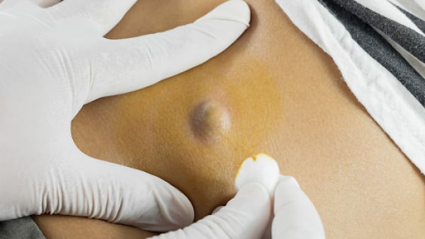 Doctor draining a cyst
