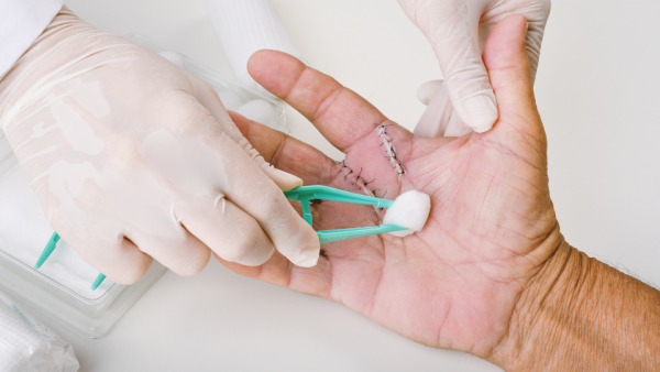 Doctor stitching up hand