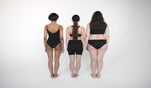Women showing lipedema and lymphedema